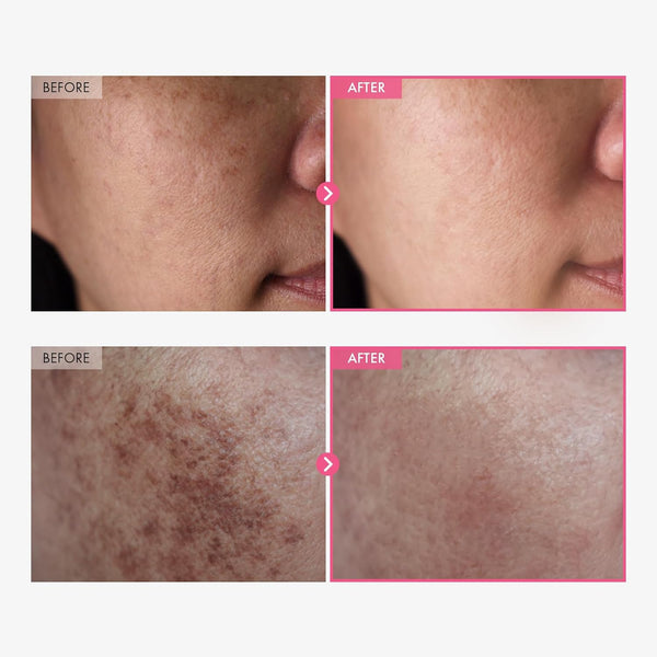 Crema Despigmentante para Manchas Oscuras